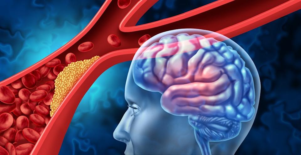 After consuming a meal high in saturated fat, blood fat levels rise and blood vessel walls stiffen, which can impair blood flow and force the heart to work harder. freshidea – stock.adobe.com