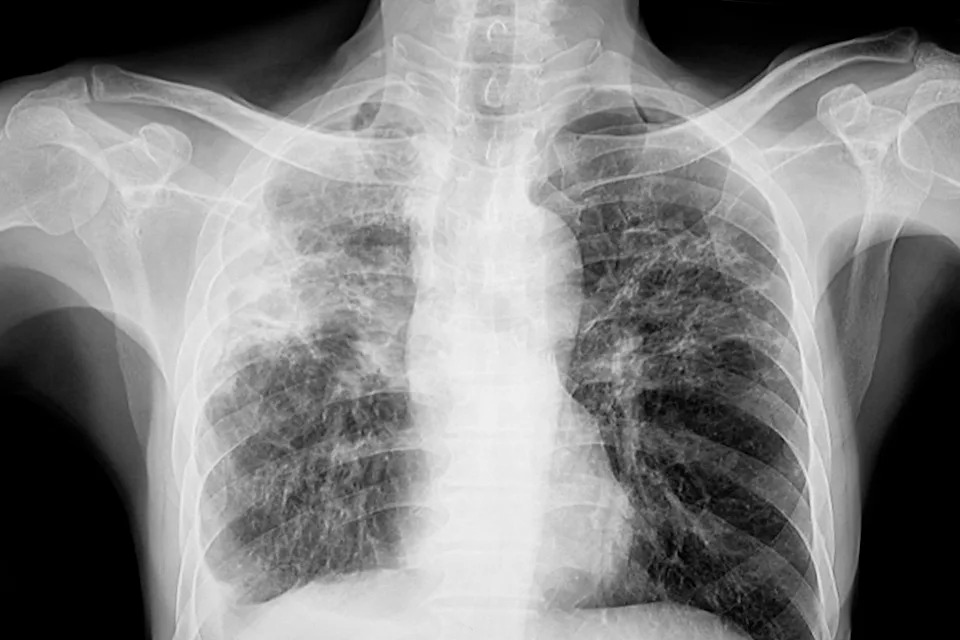 X-ray image of a human chest, showing lungs and ribcage