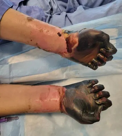 Kennedy News & Media  Jane Haley's hands after suffering tissue damage