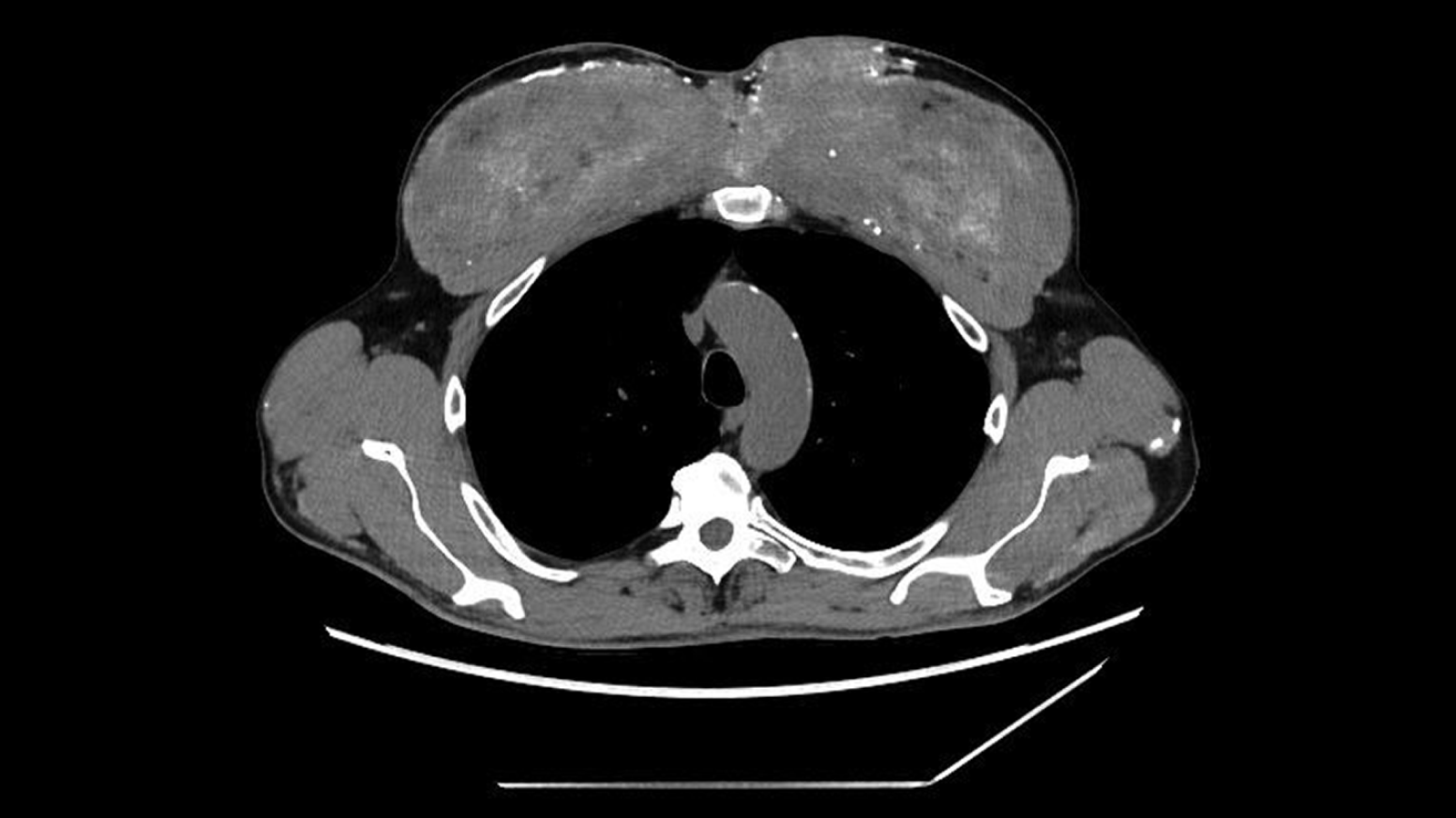 CT scan of a man's chest with bright white regions denoting calcium deposits