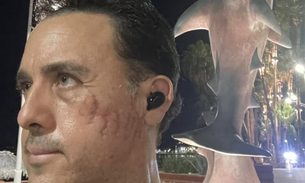 Marine Biologist Bitten by Shark in Costa Rica Aims for Reunion