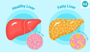 3 doctors from top hospitals in Bengaluru, Delhi, Mumbai share 5 warning signs of fatty liver written on your face