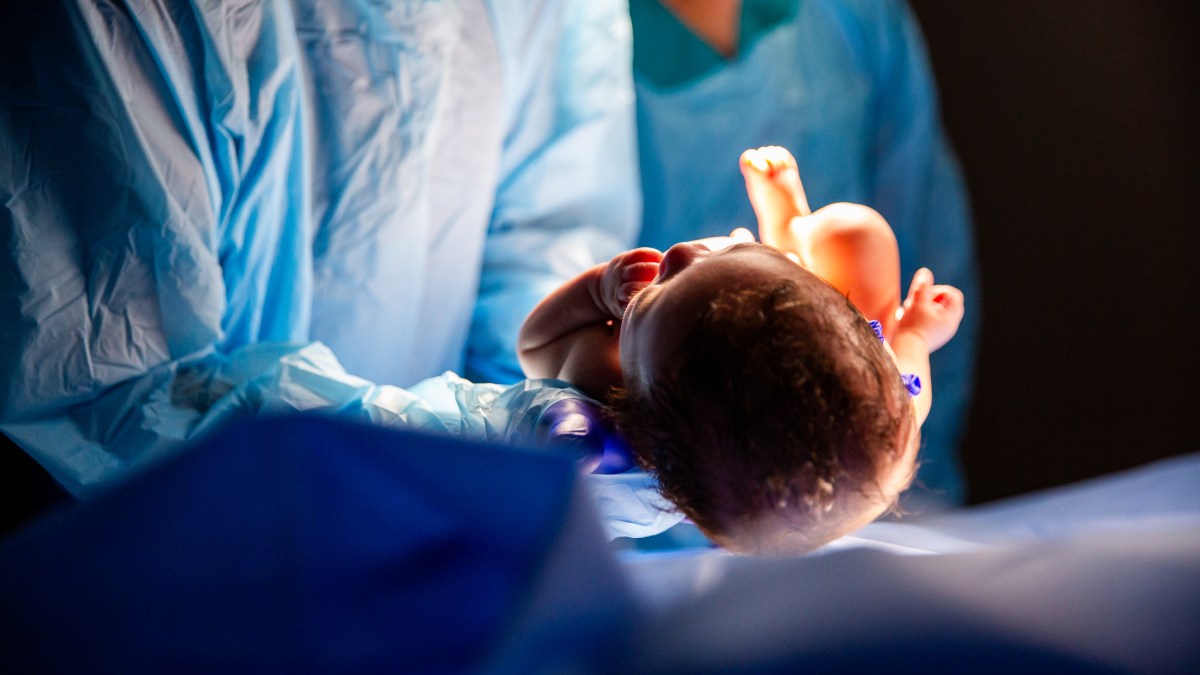 C-sections are now more common than ‘natural’ births