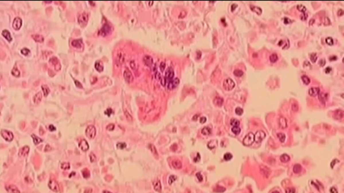 Officials warn about potential exposure to measles in Boston area