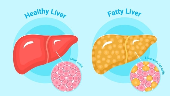 Fatty liver disease can progress to fibrosis and chronic liver failure if untreated. (Freepik)
