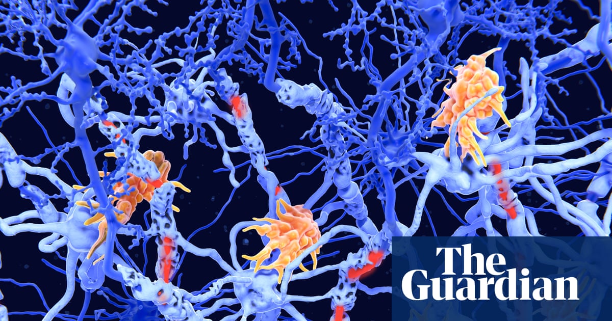 Two new subtypes of MS found in ‘exciting’ breakthrough | Multiple sclerosis