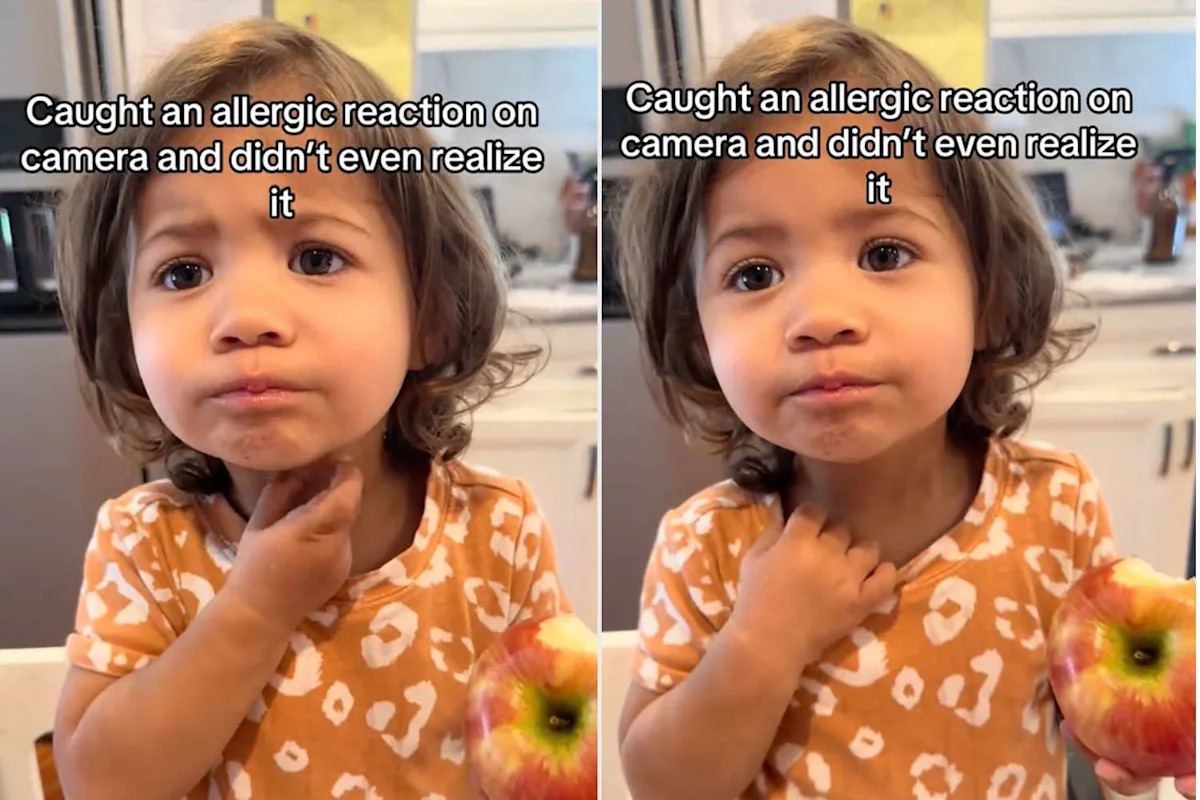 Mom Took a Video of Her Daughter Eating an Apple. She Didn't Realize She Was Capturing an Allergic Reaction (Exclusive)