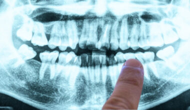 The Cause of Alzheimer's May Be Coming From Within Your Mouth : ScienceAlert