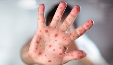 Health officials share warning after passenger with measles travels through RDU