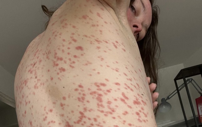 Juliette Burton ATT: Hannah Shewan Stevens - Misogynistic medical gaslighting Picture: Juliette Burton