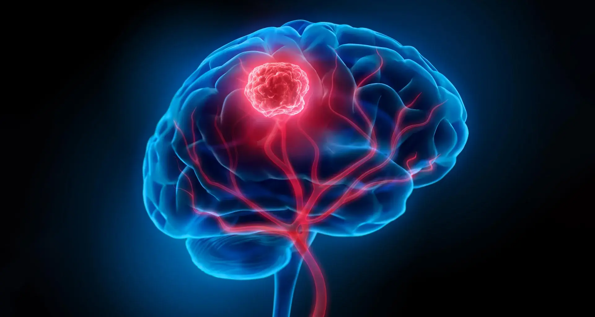 Simple supplement mix shows remarkable results in brain cancer