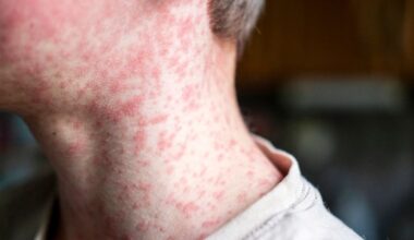 More than 2,000 measles cases reported in the US this year as ongoing outbreaks threaten elimination status