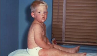 South Carolina reports 27 more measles cases in Spartanburg County as Utah count reaches 115