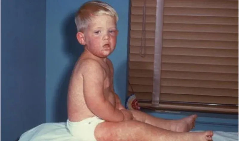 South Carolina reports 27 more measles cases in Spartanburg County as Utah count reaches 115