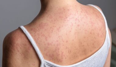 As Measles Cases Top 2,000, the U.S. Is on Brink of Losing Its Elimination Status