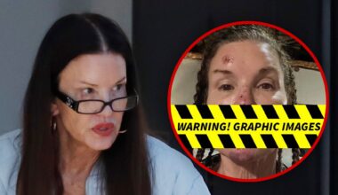 Janice Dickinson Spotted After Sharing Alleged Injuries From Reality Show Fall