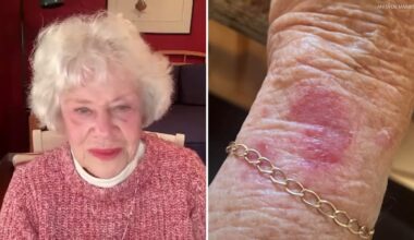 7 On Your Side: San Leandro 90-year-old's Apple Watch causes mysterious 'big red spot' on wrist