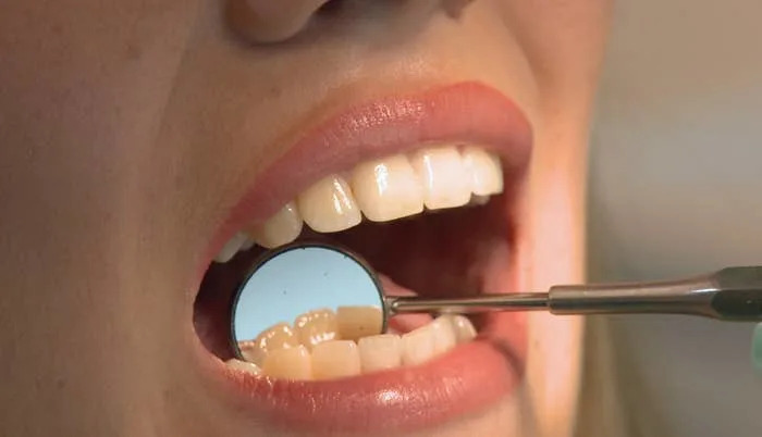 Close-up of a person’s open mouth during a dental check-up, showing teeth and a dental mirror reflecting the lower teeth