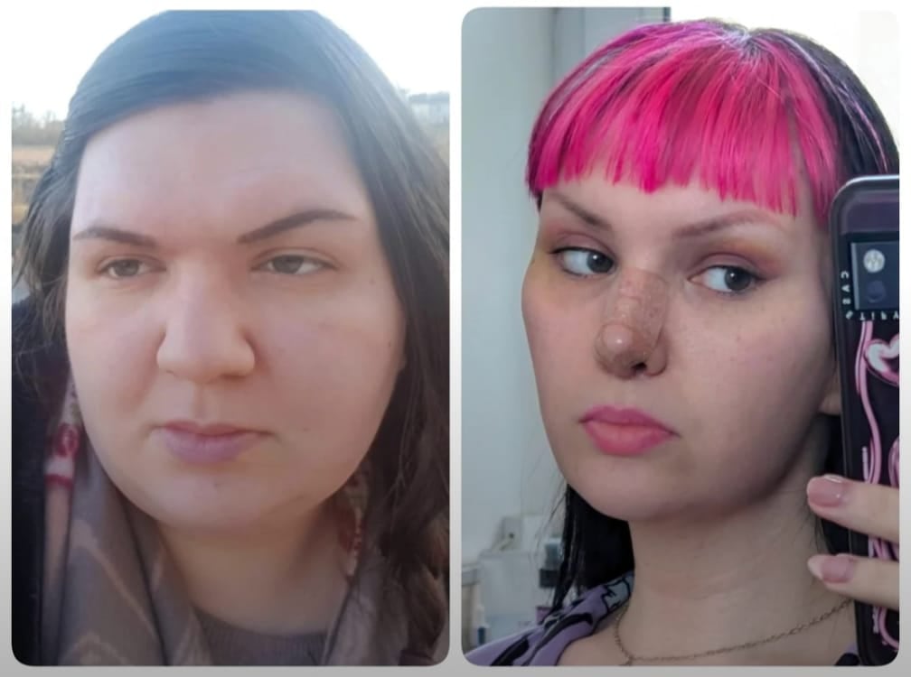 A before-and-after of the subject. Winter had a total of ten cosmetic surgeries to fix her body dysmorphia.