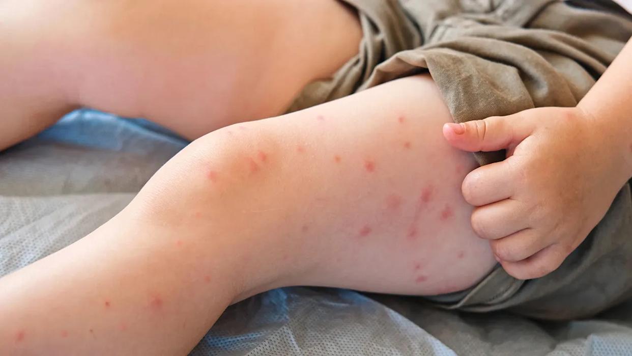 child with measles bumps on leg