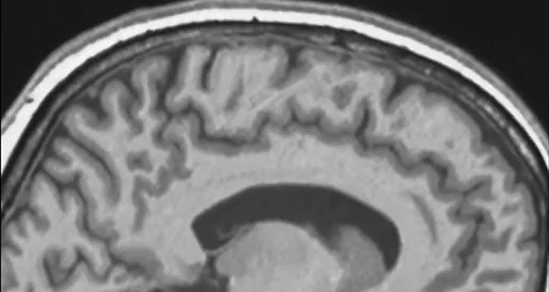 A grayscale side view of an image of the brain with patches of darker and lighter gray areas