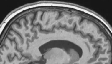 A grayscale side view of an image of the brain with patches of darker and lighter gray areas