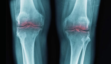 New Breakthrough to Restore Aging Joints Could Help Treat Osteoarthritis : ScienceAlert