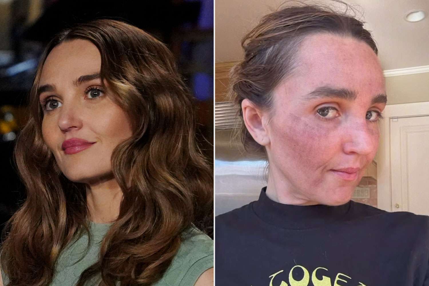 'SNL' star Chloe Fineman shares 'botched' photos from med spa procedures