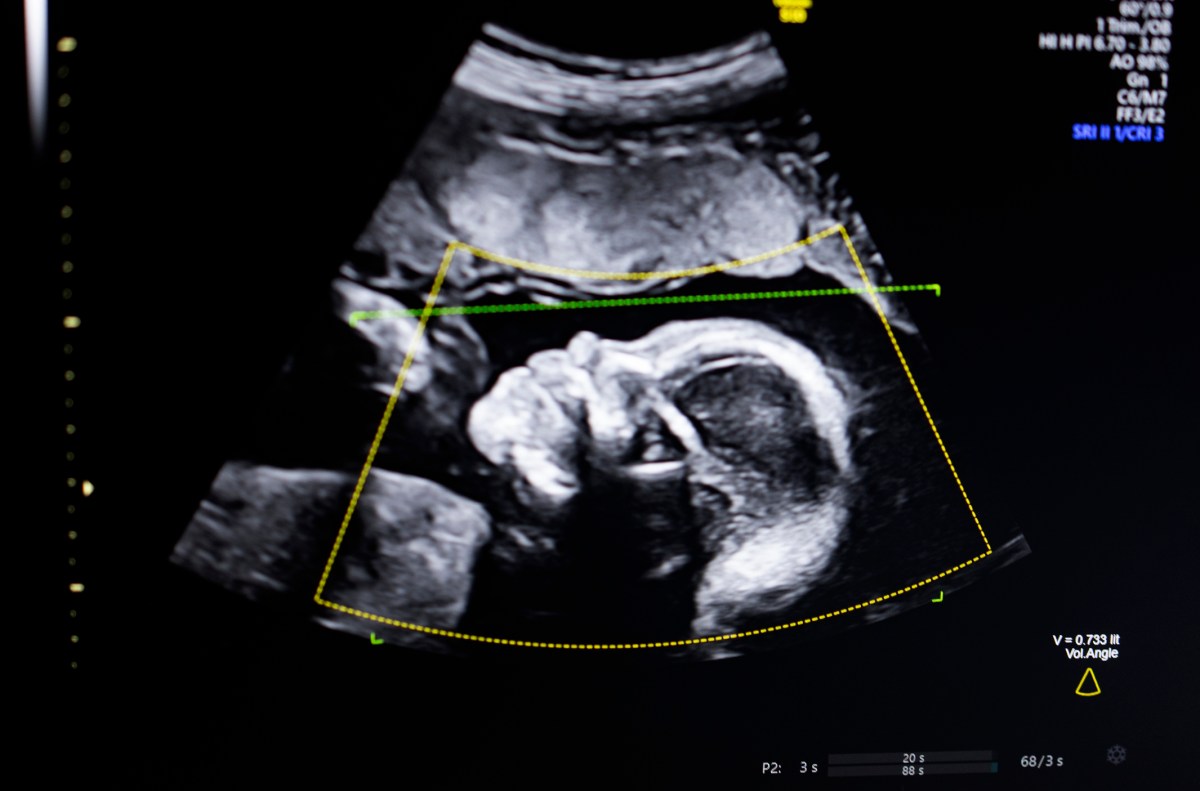 BioticsAI, which won Disrupt's Battlefield competition in 2023, gains FDA approval for its AI-powered fetal ultrasound product 