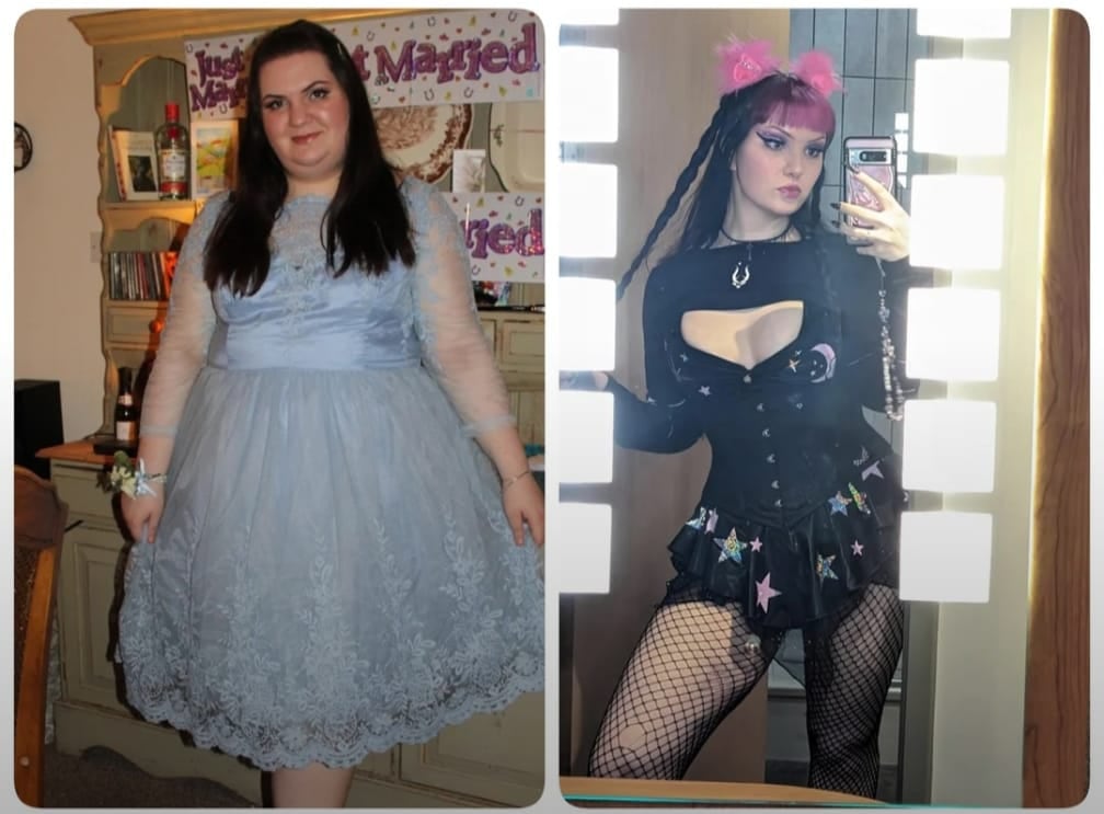 A before-and-after of the subject. Winter had a total of ten cosmetic surgeries to fix her body dysmorphia.