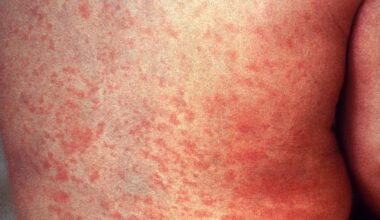 VDH confirms another measles case