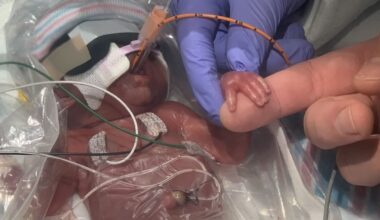 Tiny Baby Born With Hands Smaller Than a Fingertip is Now Home After a Year–And Developing Normally