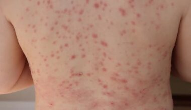 Health officials tracking measles outbreak in Ohio