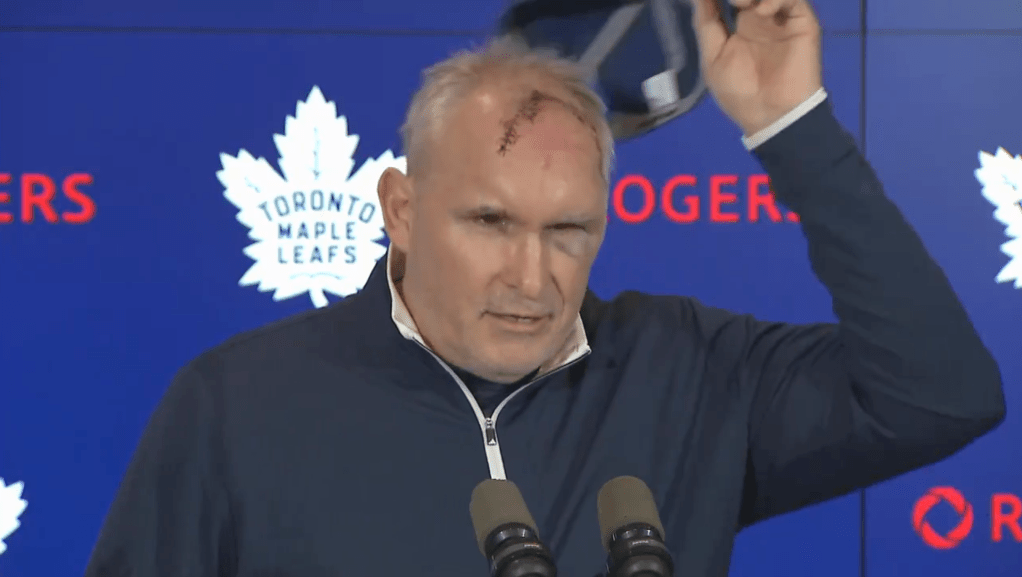 Craig Berube showed off a gnarly cut on his head after what he described a a gym accident.