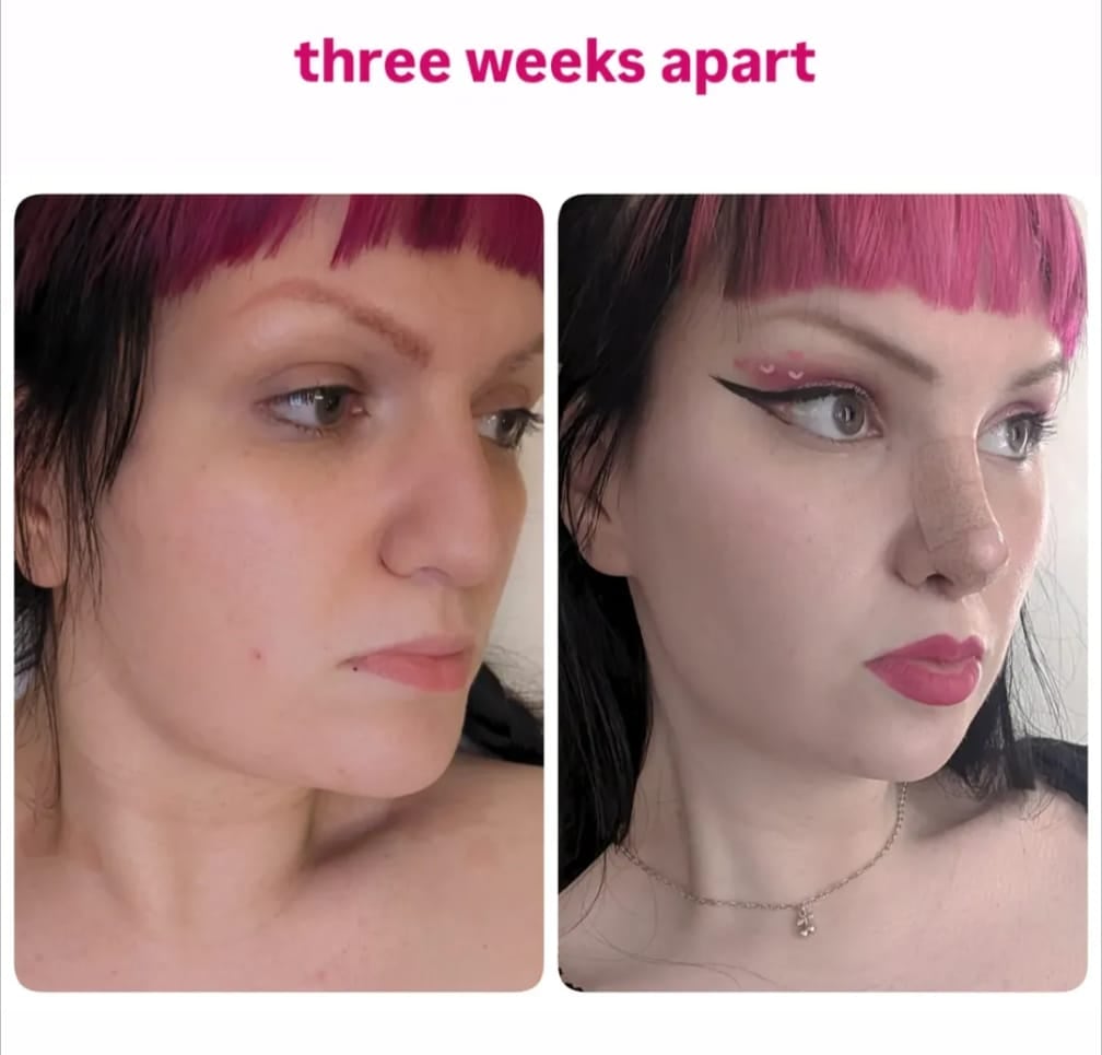 A before-and-after of the subject. Winter had a total of ten cosmetic surgeries to fix her body dysmorphia.