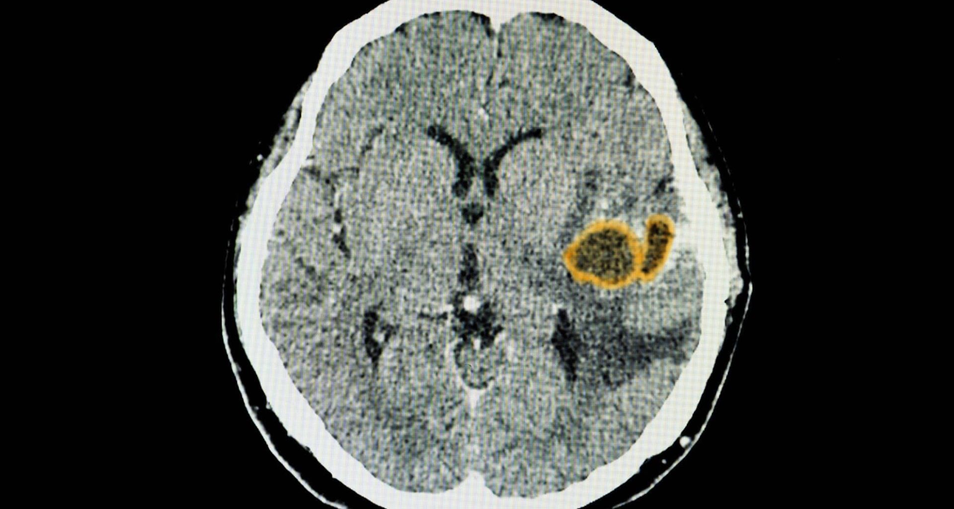 Brain Parasite (illustrative Image)