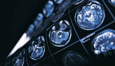 What If Cancer Holds the Key to New Treatments for Alzheimer's Disease?