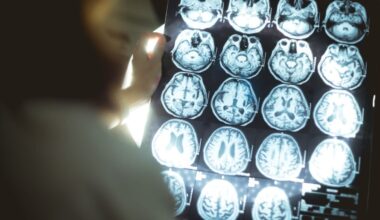 Youngest UK Dementia Case Dies at 24