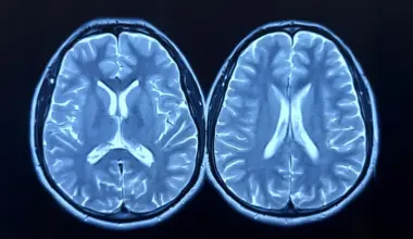 MRI scans show exercise can make the brain look younger