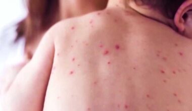 99 new cases of measles in South Carolina outbreak
