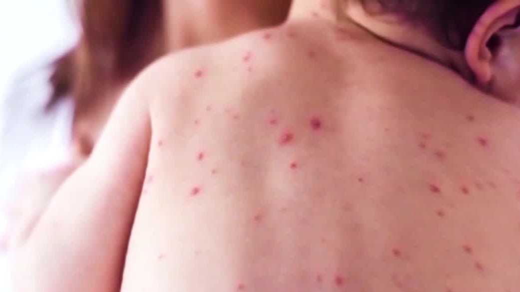 99 new cases of measles in South Carolina outbreak
