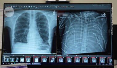 artificial organ kept man alive until transplant