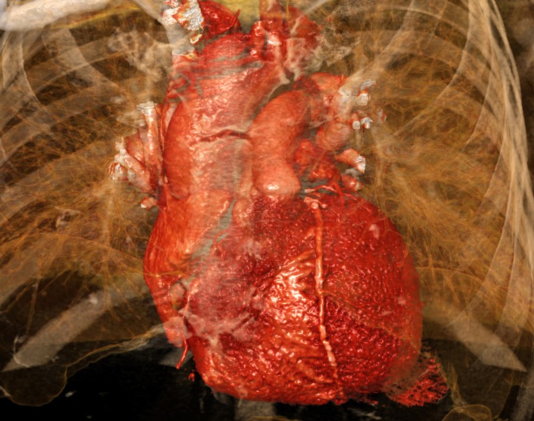 A coloured 3D CT angiogram scan of a human heart framed by the ribcage.