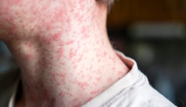 Measles cases surge in South Carolina as U.S. risks losing elimination status