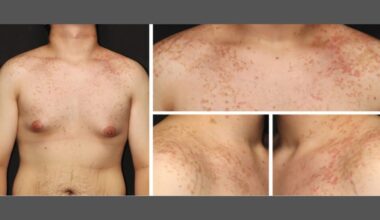 Man's Switch to Keto Diet Triggers Bizarre, Rare Rash