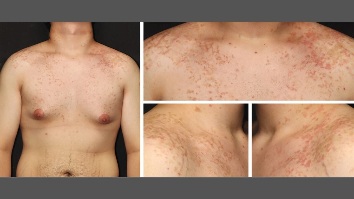 Man's Switch to Keto Diet Triggers Bizarre, Rare Rash