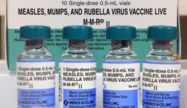 SC measles outbreak has gone berserk: 124 cases since Friday, 409 quarantined