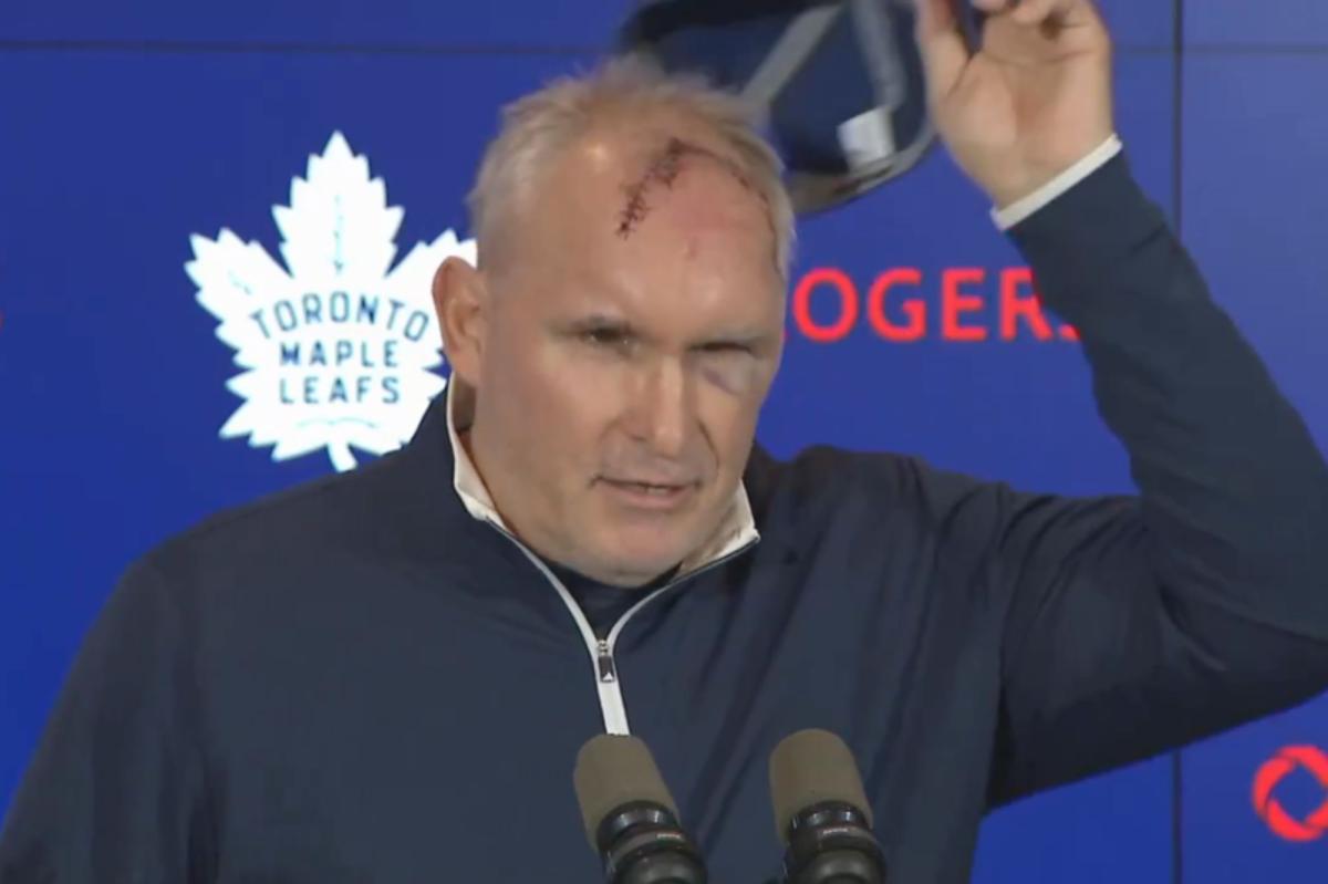 Maple Leafs' Craig Berube shows off terrifying cut after gym accident