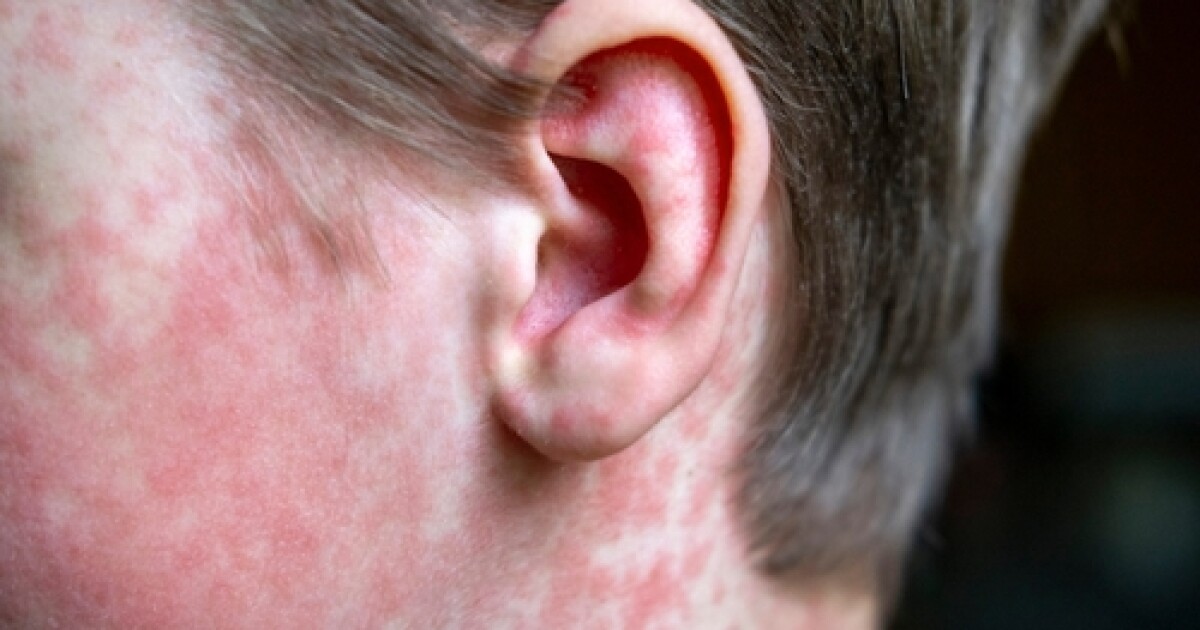 Pima County Health officials investigate new measles case