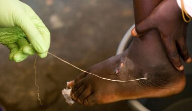 World creeps closer to eradicating human Guinea worm cases, with just 10 last year: Carter Center